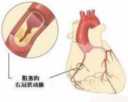 心血管和血栓栓塞綜合征 心血管和血栓栓塞綜合征