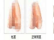 包皮包莖