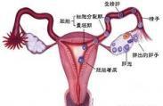 輸卵管狹窄