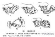 先天性腸狹窄