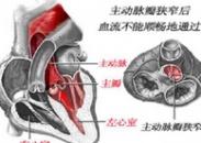 小兒先天性主動脈瓣狹窄 小兒先天性主動脈瓣狹窄