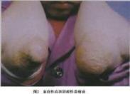 家族性混合型高脂血癥
